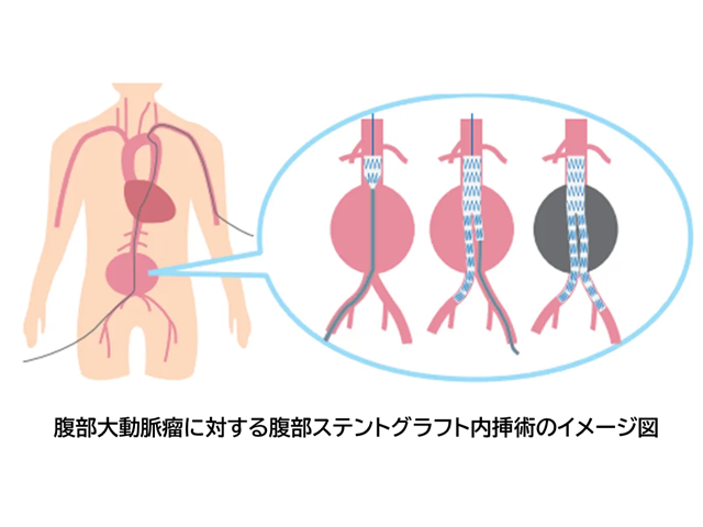 腹部ステントグラフト内挿術イメージ図