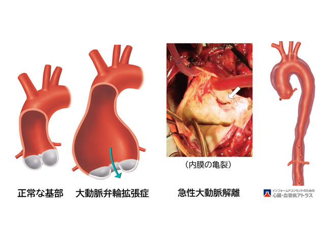 大動脈弁輪拡張症
